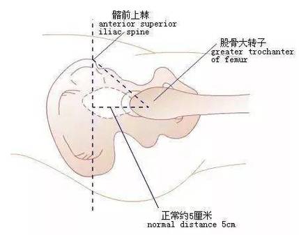 nelaton线截图