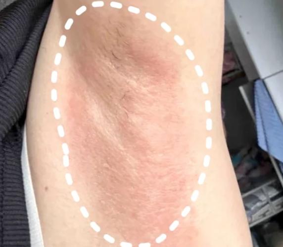 腋下无痒痒要揉通不