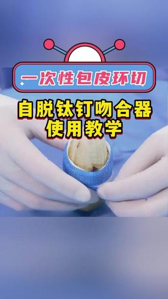 怎么加速吻合钉脱落