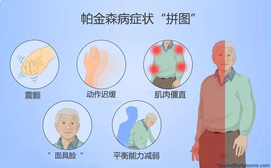 帕金森综合征四大症状