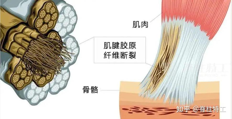 肌肉纤维断裂图片截图