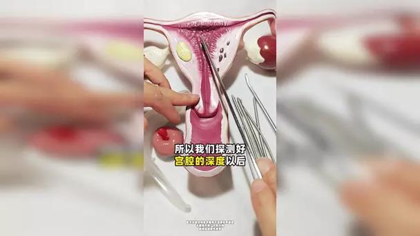 人流吸宫术过程视频