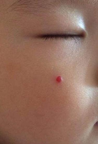 宝宝脸上被圆珠笔头戳了个洞截图