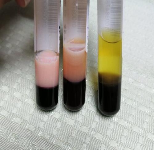 女子吃完饭后抽出“牛奶血”