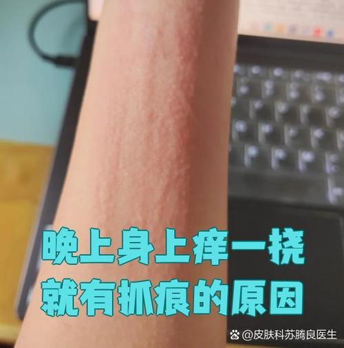 身上出现像抓痕一样的怎么回事