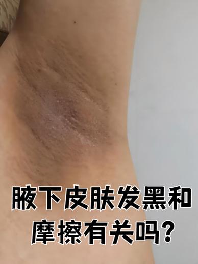 腋下黑怎么办