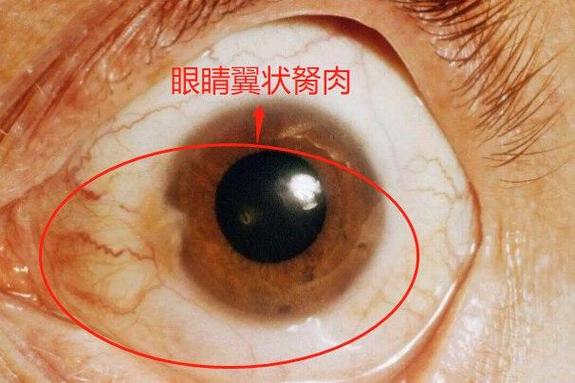眼睛胬肉怎么形成的
