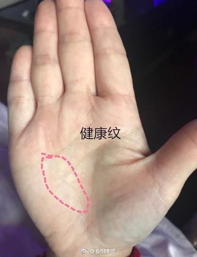 正常的健康线的图片