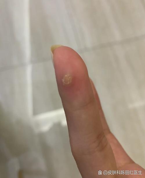 手指上有个白色凸起按压疼痛