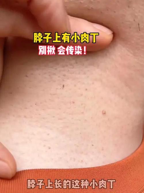 身上长小肉丁丁是怎回事