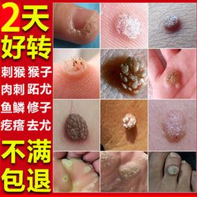 肉刺可以用什么办法把它消除