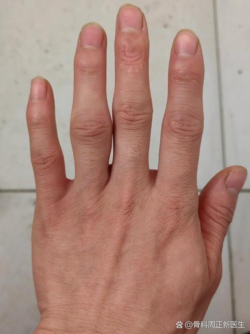 左手大拇指根部骨头疼是什么原因