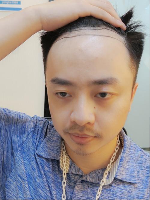 雍禾植发效果怎么样