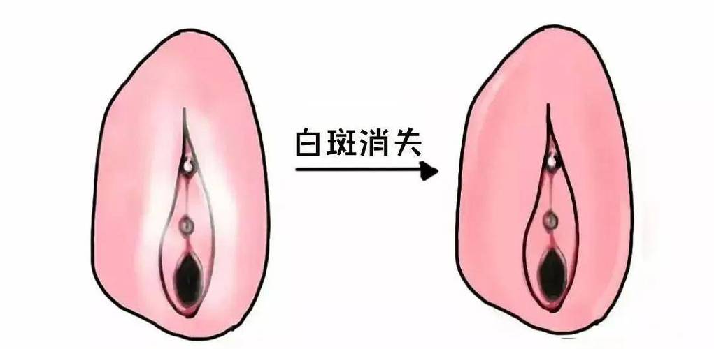 外阴白斑影响夫妻生活吗