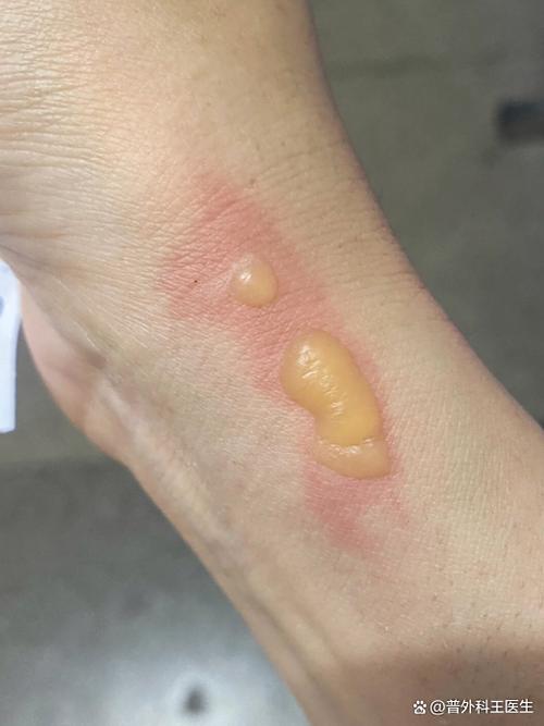 被烫伤起水泡怎么办