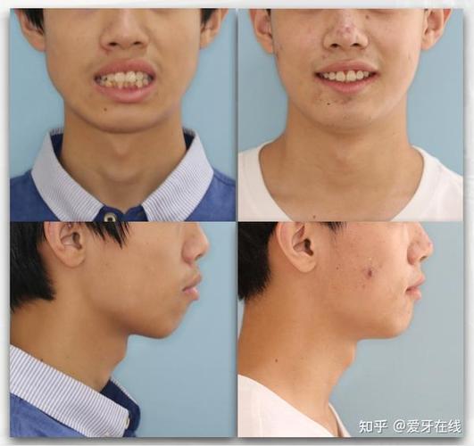 整牙齿矫正缩略图