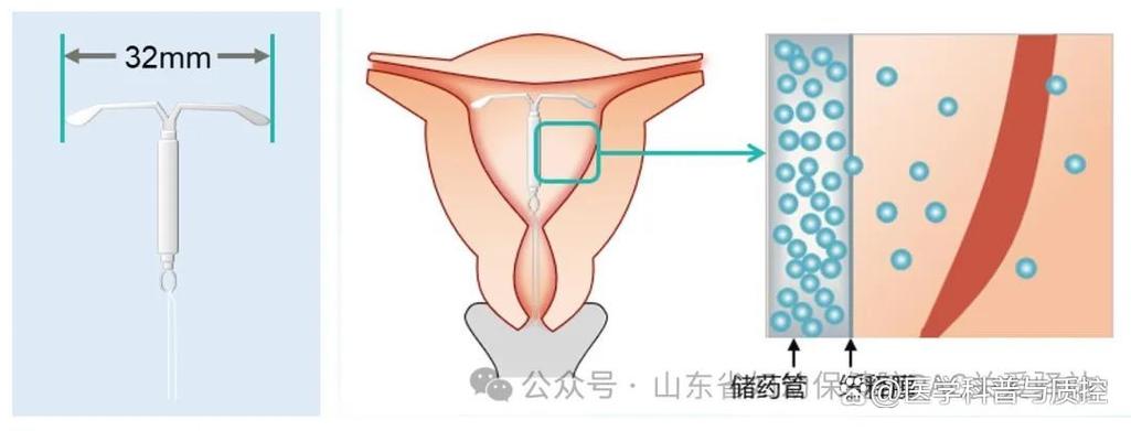 曼月乐环多久能同房