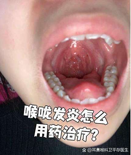 急性咽喉炎的三个阶段