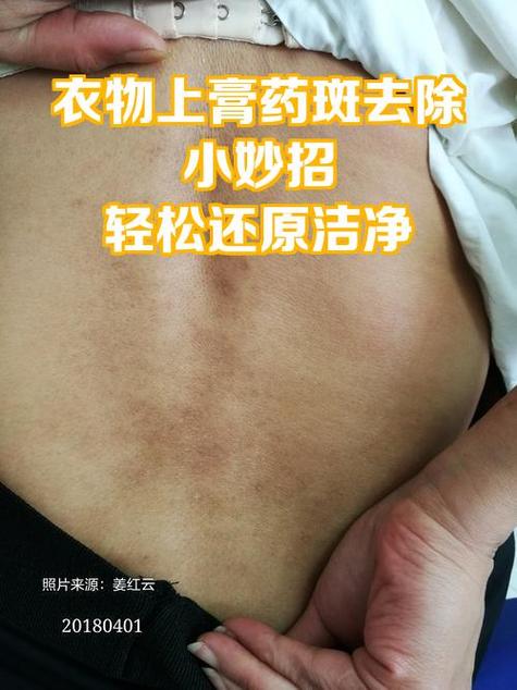衣服粘上膏药怎么去除掉缩略图