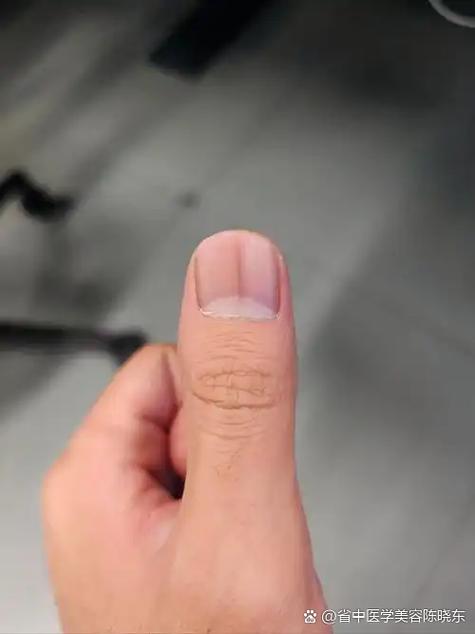 女性指甲有黑线要警惕截图