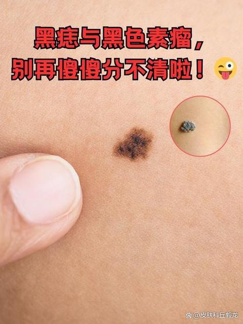 看黑痣挂什么科缩略图