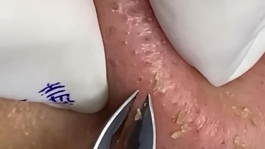 挑黑头的解压视频截图