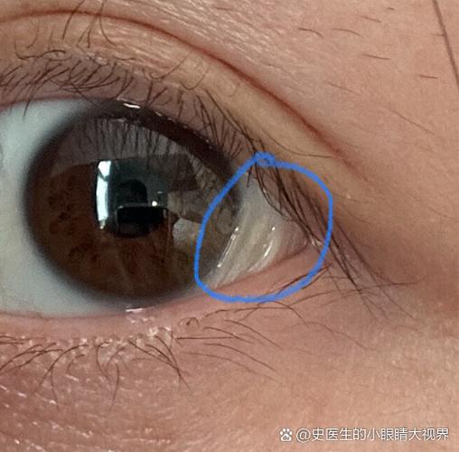 白眼球褶皱能自愈吗