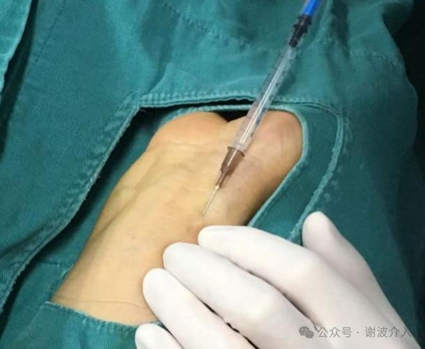 术前针怎么打