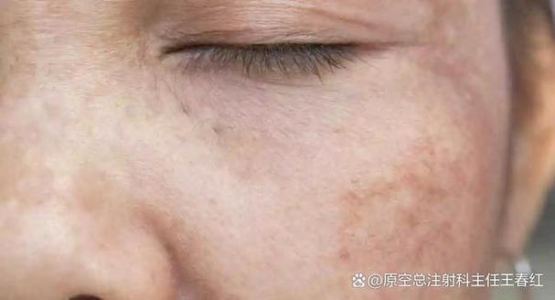 脸上出现圆形斑块是什么原因