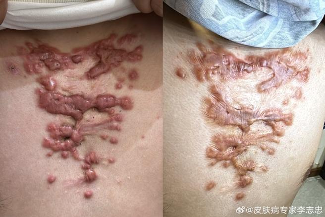 瘢痕疙瘩是什么病