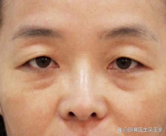 突然一只眼皮往下塌怎么办
