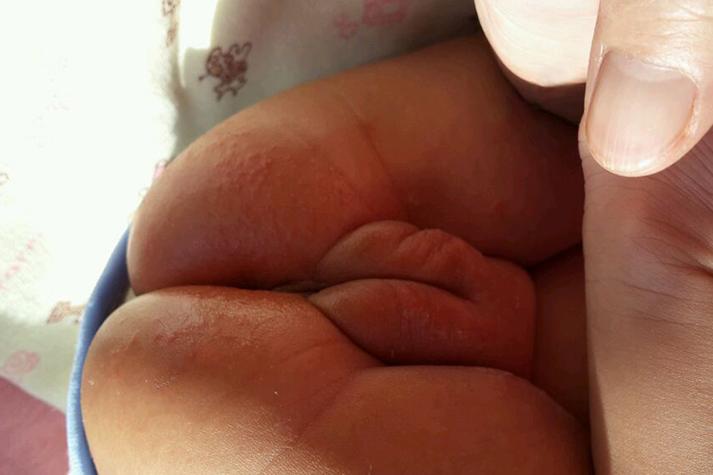 女性肛门周围溃烂发痒