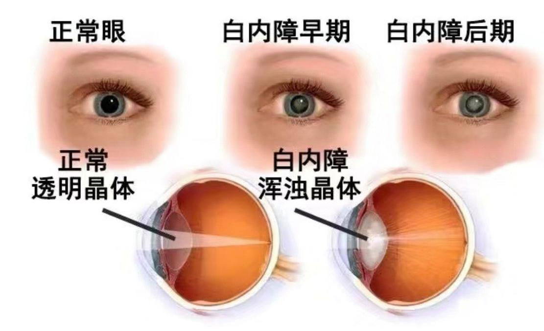 眼球白内障图片