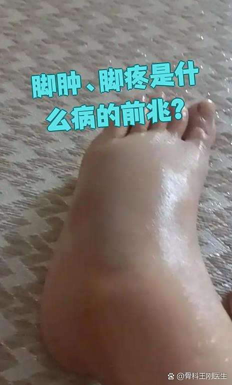 男人脚肿是什么病的前兆
