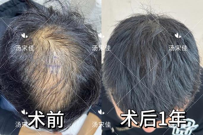 植发头顶加密效果好吗
