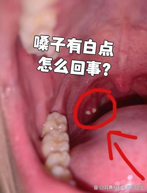 嗓子发炎