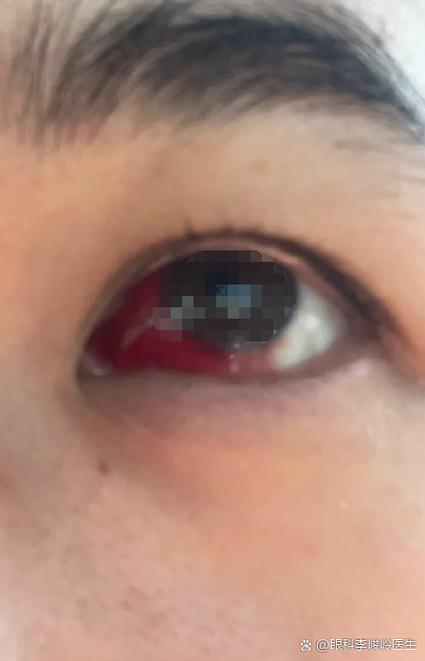 玩手机久了眼睛红了怎么办