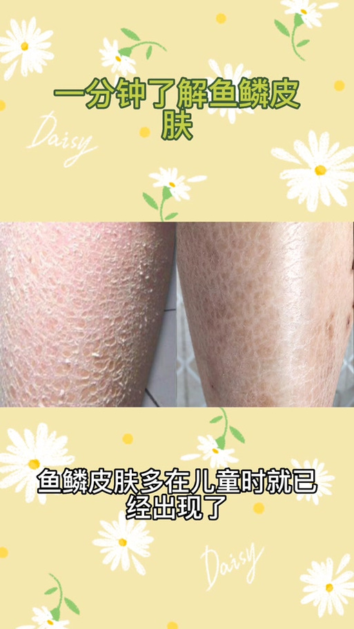 蛇皮治什么病缩略图