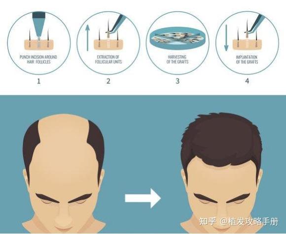 纹头发和植头发哪个好