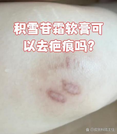 伤疤黑色素沉淀用什么药膏好