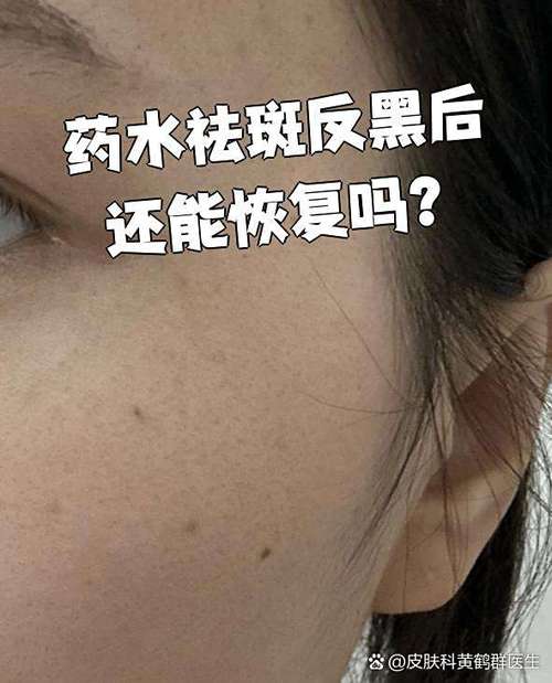 祛斑反黑了还能白回来吗