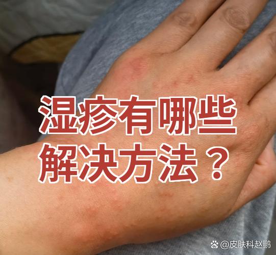 英柚霜去湿疹有效果吗