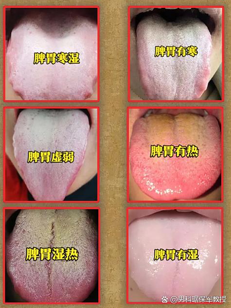 脾胃虚弱的人舌头图片