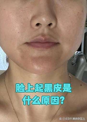 皮肤变黑