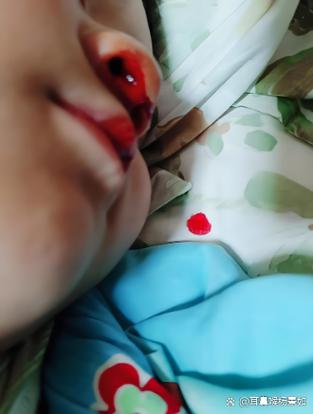 孩子流鼻血