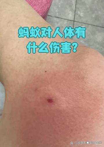 蚂蚁的应急反应是什么缩略图