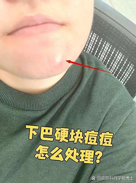 下巴长痘还有硬块截图