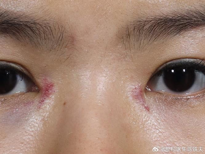 开眼角留疤了怎么去除