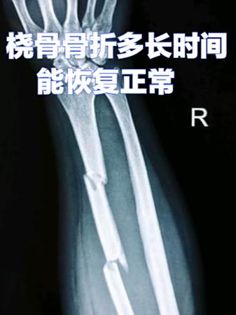 手腕骨折要多久才能好