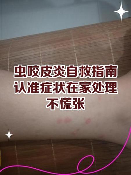 我住旅馆被虫子咬了怎么办
